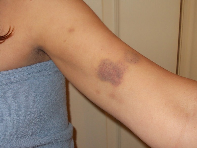 One of the bruises Anna says she received after being manhandled by a police officer. Photograph: Anna Davison