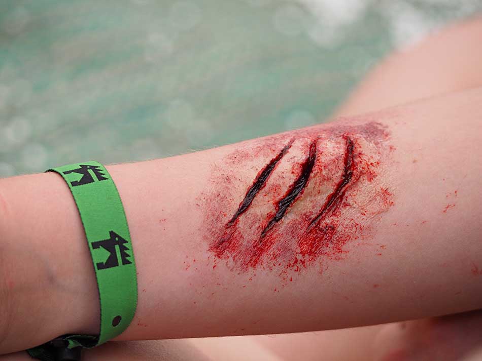 A scar on an arm