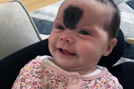York parents launch fundraising campaign to remove huge facial birthmark on baby Vienna – after NHS refused surgery